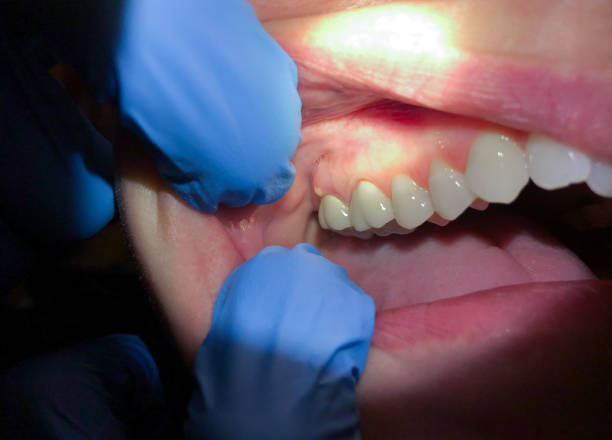 Best Emergency Wisdom Tooth Extraction in Cedar Point, NC